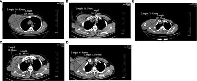 Apatinib manifests an unexpectedly favorable outcome in the management of axillary lymph node follicular dendritic cell sarcoma: a case report